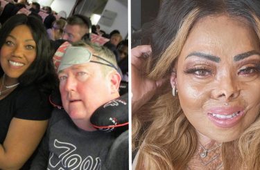 Marido queima esposa por acidente modificando seu rosto para sempre e ela o perdoa