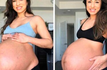 Mãe viraliza ao mostrar comparação do corpo antes e depois de dar à luz gêmeos